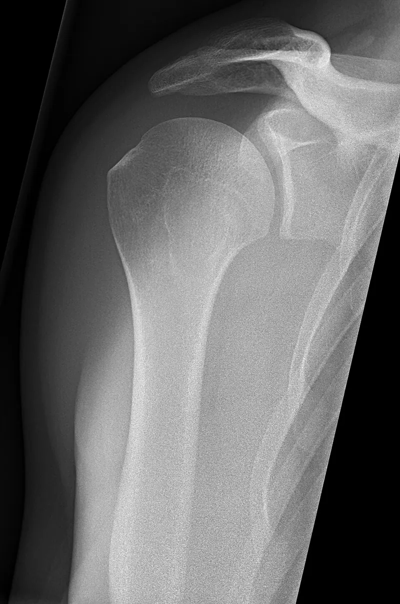 X-ray of a human shoulder joint