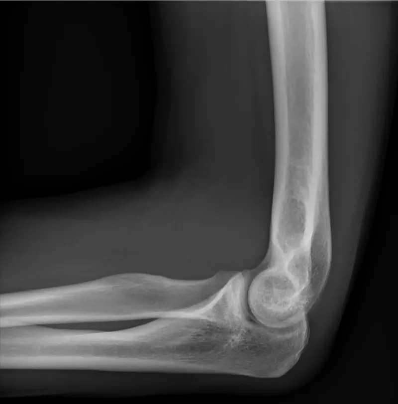 X-ray of a bent elbow seen from the side