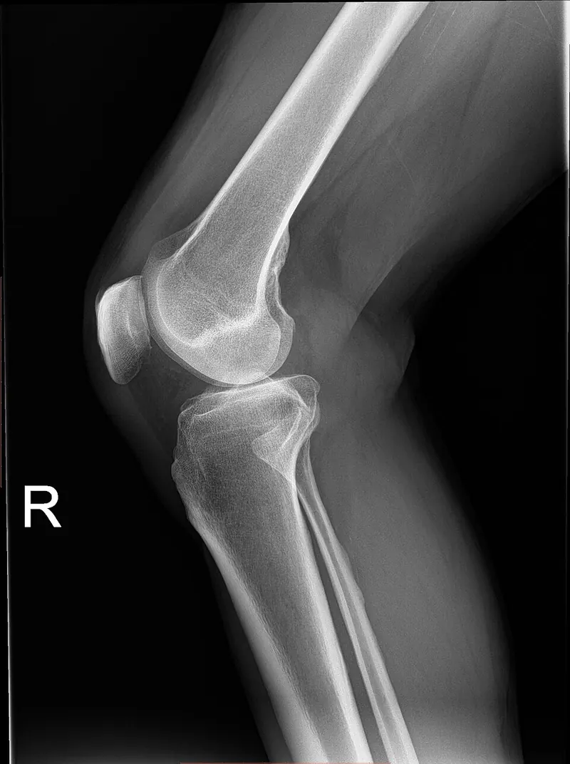 X-ray of a knee seen from the side